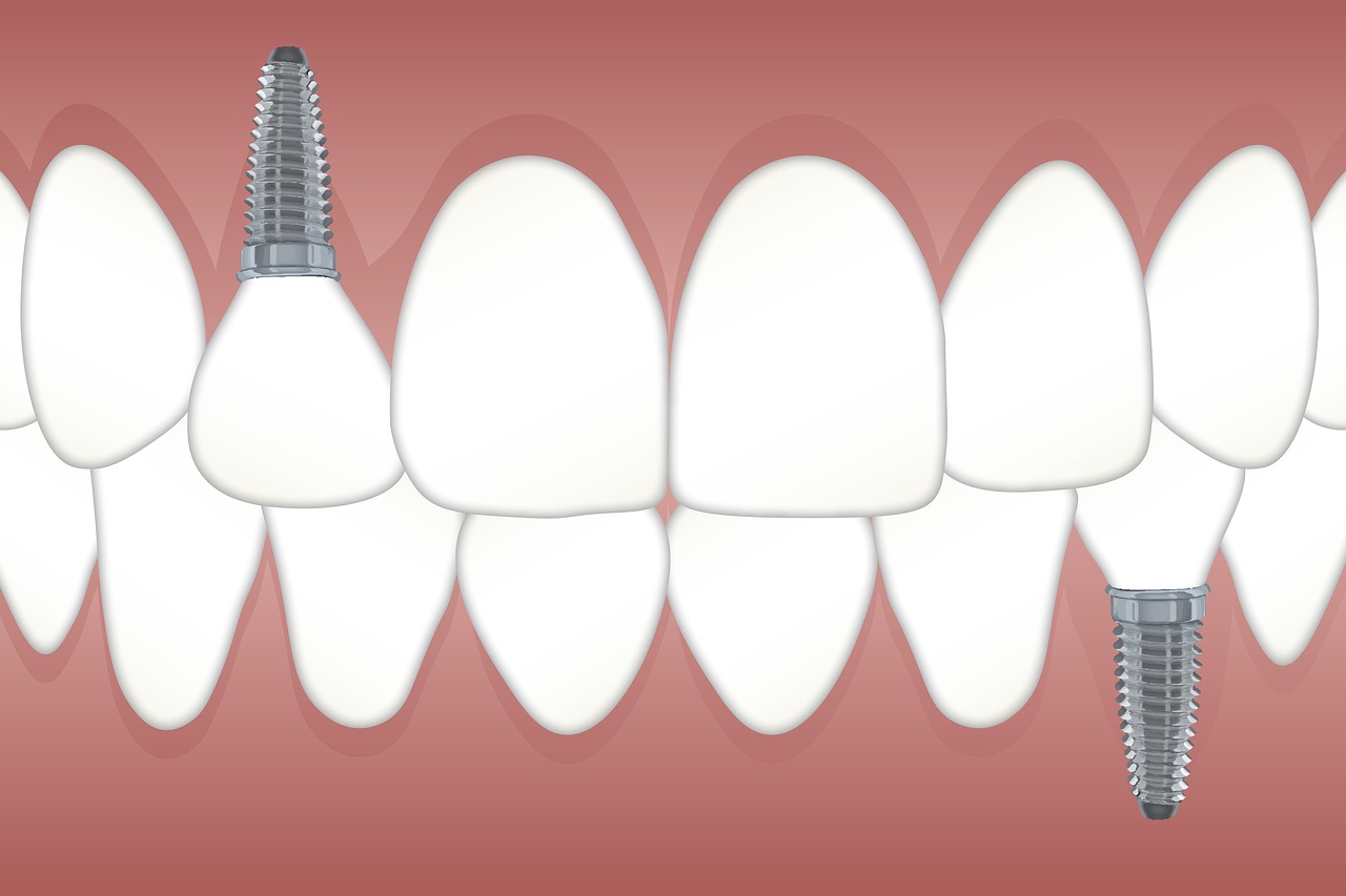 Rodzaje implantów zębowych